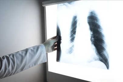 Yaşam Şansı Yüzde 90'ı Aşıyor